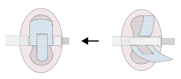 Hot to implement securement device