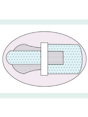 scurement device