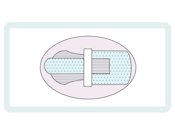 scurement device