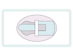 scurement device